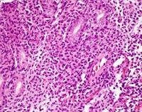 NKcell-enteropathyHE