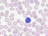 Beta-thalassemia trait-Blood