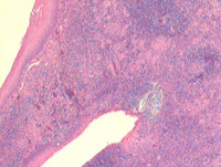 EBV reactivation in older person