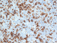 EBV-reactivationCD20