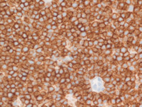 Myeloma-with-Cyclin-D1