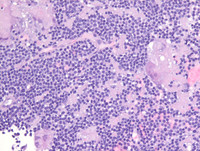 Plasma cell myeloma with t(11;14)