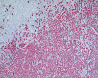 NLPHL-with-progression