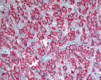 NLPHL-with-progression