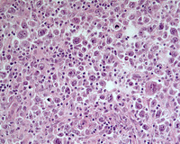 NLPHL-with-progression