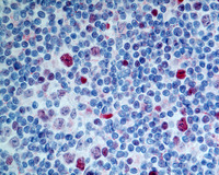 NLPHL-with-progression