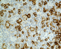 NLPHL-with-progression