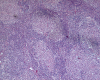 NLPHL-with-progression