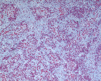 NLPHL-with-progression