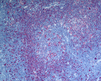 NLPHL-with-progression