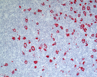 NLPHL-with-progression