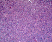 NLPHL-with-progression