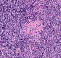 Kimura's Disease 3