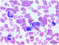 Erythrophagocytosis on the peripheral blood smear