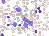 DLBCL variant of Richter Transformation in CLL 1