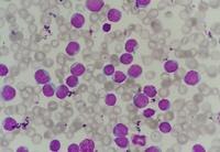 Chronic lymphocytic leukemia (CLL) with presence of pro-lymphocytes 1