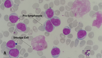 Chronic lymphocytic leukemia (CLL) with presence of pro-lymphocytes 6