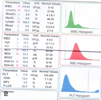 Chronic lymphocytic leukemia (CLL) with presence of pro-lymphocytes 9