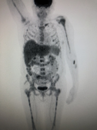 Breast Cancer Metastasis 2