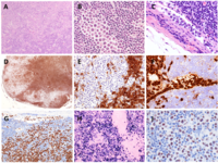 Nodal extracavitary variant of primary effusion lymphoma as complication of chronic lymphocytic leukemia: a previously unreported variant of Richter's syndrome