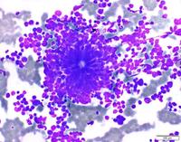 Neuroblastoma rosette in the bone marrow aspirate smear