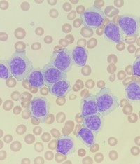 Marginal zone B-cell lymphoma blood smear