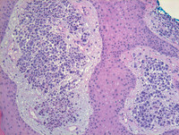 Myeloma-Low power - H & E