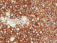 Mantle cell lymphoma with mantle zone pattern-5