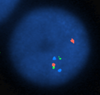 AML with recurrent t(3;3)