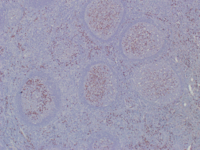 IgG positive plasma cells