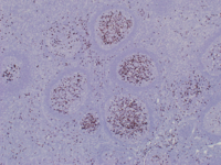 IgG4 positive plasma cells