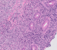 MALT/Extra-Nodal Marginal Zone Lymphoma H&E