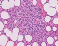 Lymphoplasmacytic Lymphoma H&E