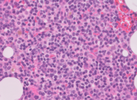 Lymphoplasmacytic Lymphoma H&E High Power