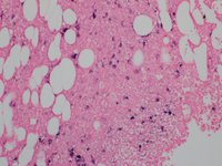 Kappa Insitu hybridization- most plasma cells are kappa light-chain positive.