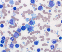 CML Megakaryocytic Blast Crisis