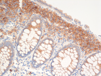 Mastocytosis CD25