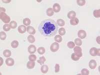 Dsyplastic Neutrophil