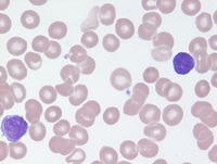 Mycosis Fungoides Blood