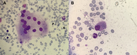 Osteopetrosis