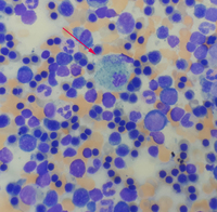 Hemolytic Anemia