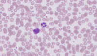 CML-Accelerated Phase-Blood