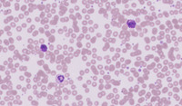 CML-Accelerated Phase-Blood