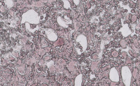 CML-Accelerated Phase-Reticulin