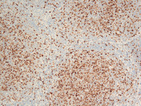 Follicular Lymphoma Grade 3a-Ki67