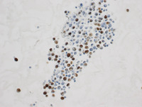 Primary Effusion Lymphoma-EBER