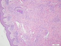 Primary Effusion Lymphoma Hande 1716