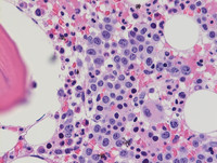 Paroxysmal Nocturnal Hemoglobinuria-H&E High Power