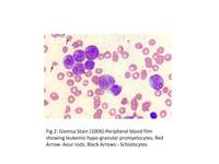 Microgranular acute promyelocytic leukemia with hyperleukocytosis and autoimmune hemolysis 2