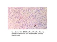 Microgranular acute promyelocytic leukemia with hyperleukocytosis and autoimmune hemolysis 3